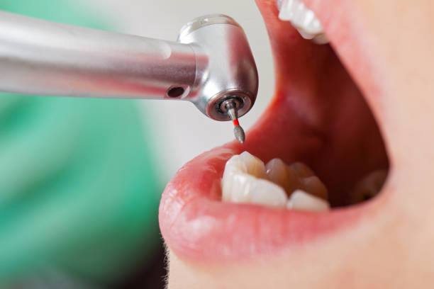 Best Emergency Dental Surgery in University Of Lifornia Santa Barbara, CA